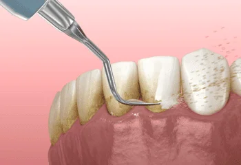 Teeth Cleaning and Polishing