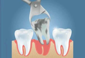 Tooth Extraction