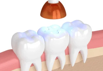Dental Filling