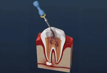 Root Canal