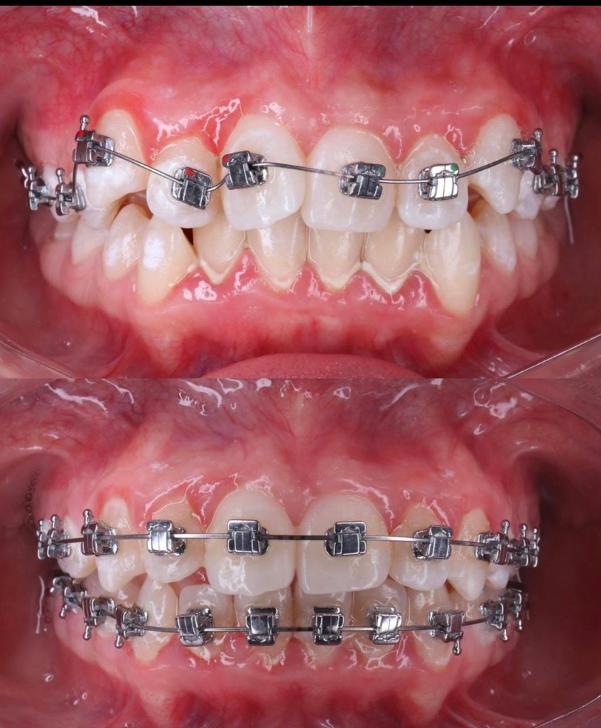 Teeth Alignment Case - Braces