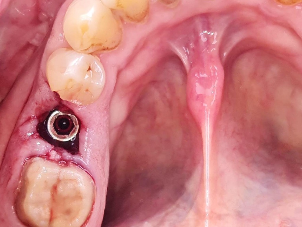 Dental Implant Case - Implants