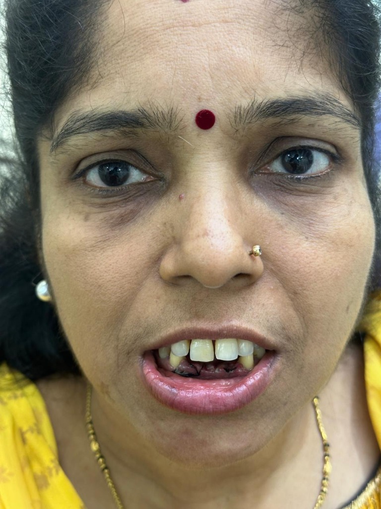 Dental Implant Case - Implants