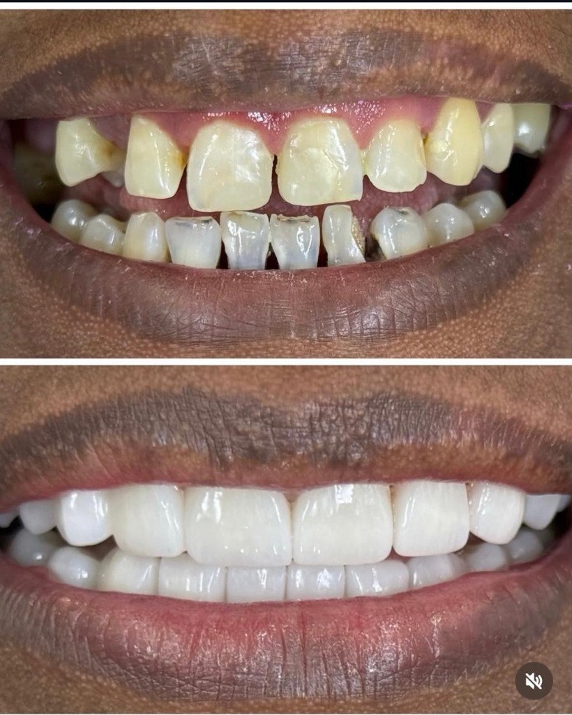 Smile Makeover Case - Cosmetic Veneers